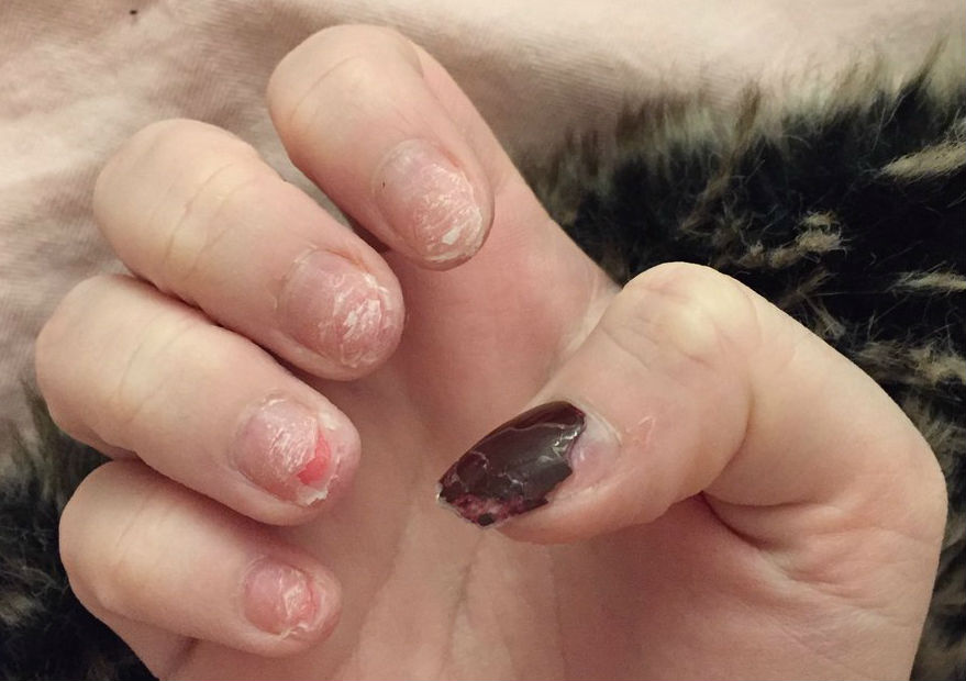 Five reasons not to use acrylic nails on toes